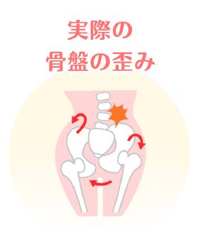 実際の骨盤の歪み